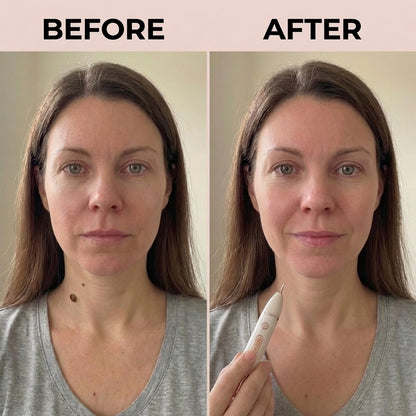 QUILLEA SKIN TAG REMOVAL PEN