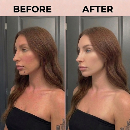 QUILLEA SKIN TAG REMOVAL PEN